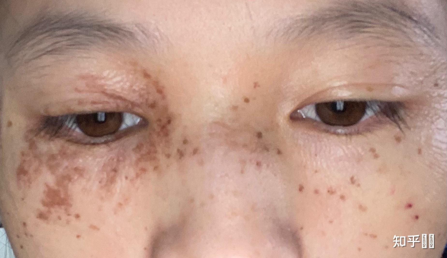 雀斑样痣有治愈的吗?哪里做的好? - 知乎