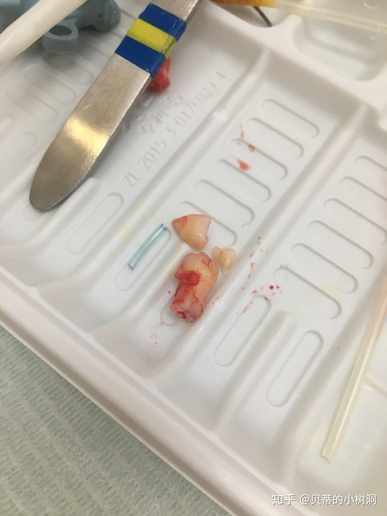 第一次拔智齿是什么感觉