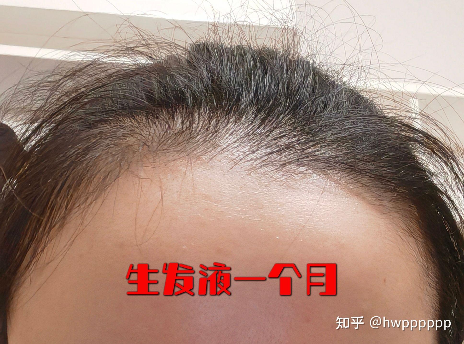 生发液使用全记录 - 知乎