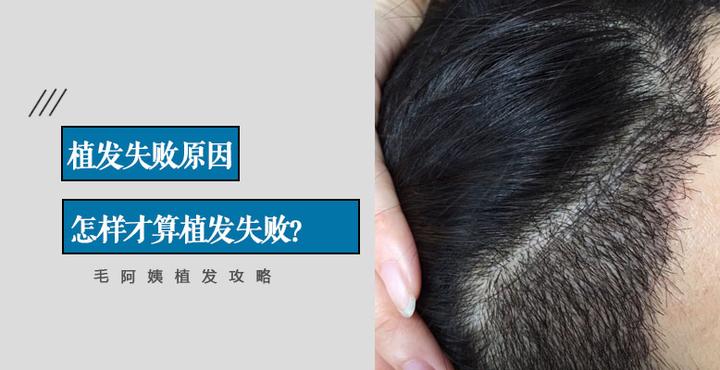 植发失败原因：怎样才算植发手术失败？ - 知乎