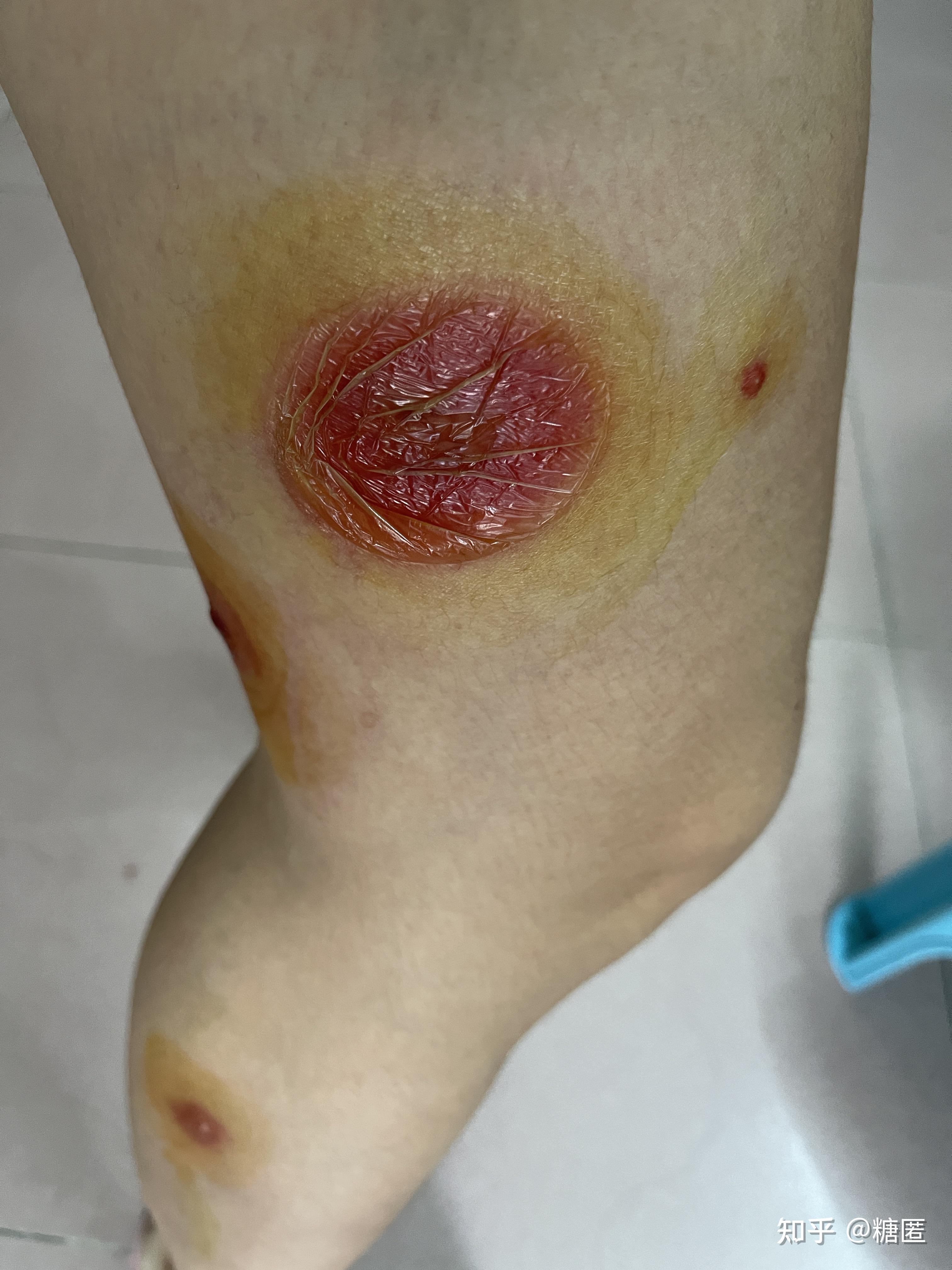 被毒蚊子咬了肿了很大一个包还很硬之后肿的包上面起了水泡挑破之后第