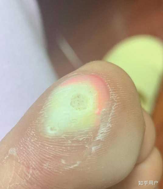 贴完鸡眼贴以后把白色的皮撕掉了然后又贴了个鸡眼贴贴了两天以后起了