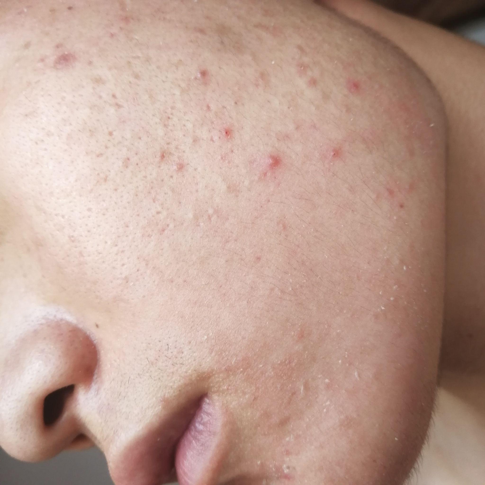 阿达帕林凝胶灼烧蜕皮? - 知乎