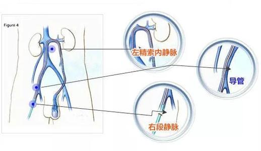 左侧重度精索静脉曲张术后仍然有明显的静脉团块招飞体检淘汰吗? - 知乎