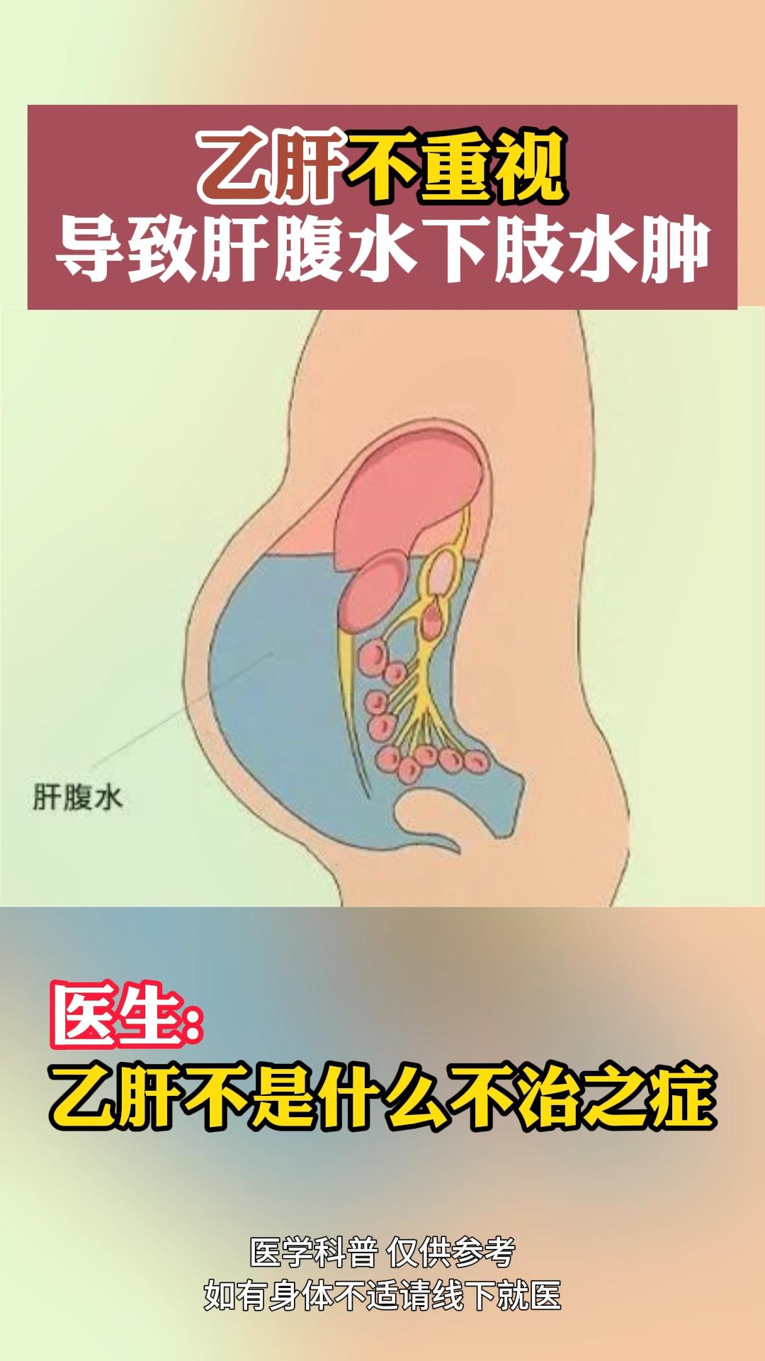 肚子胖和肝腹水区别图图片