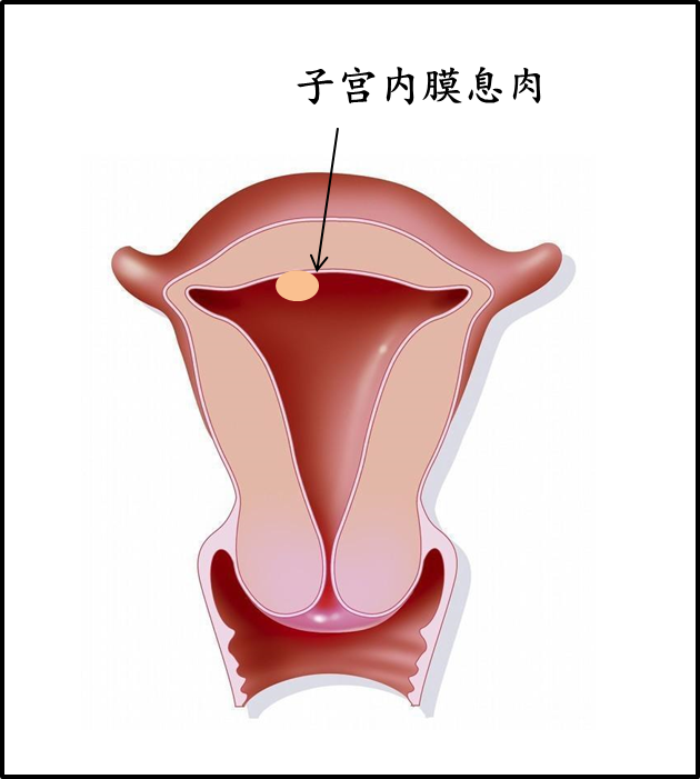 同样是子宫内膜息肉为什么处理却不同