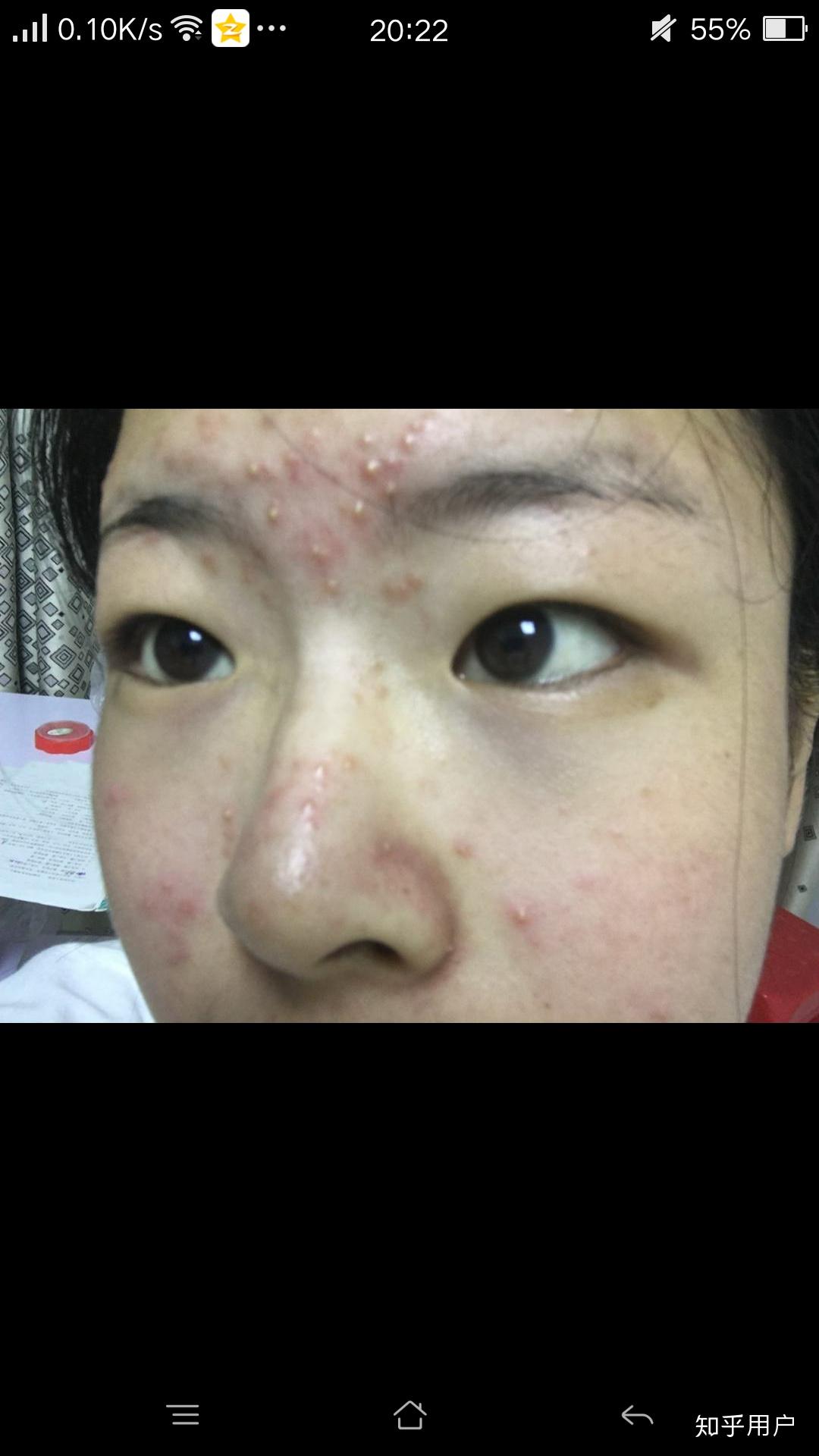 长期使用维a酸乳膏涂全脸会有什么后果