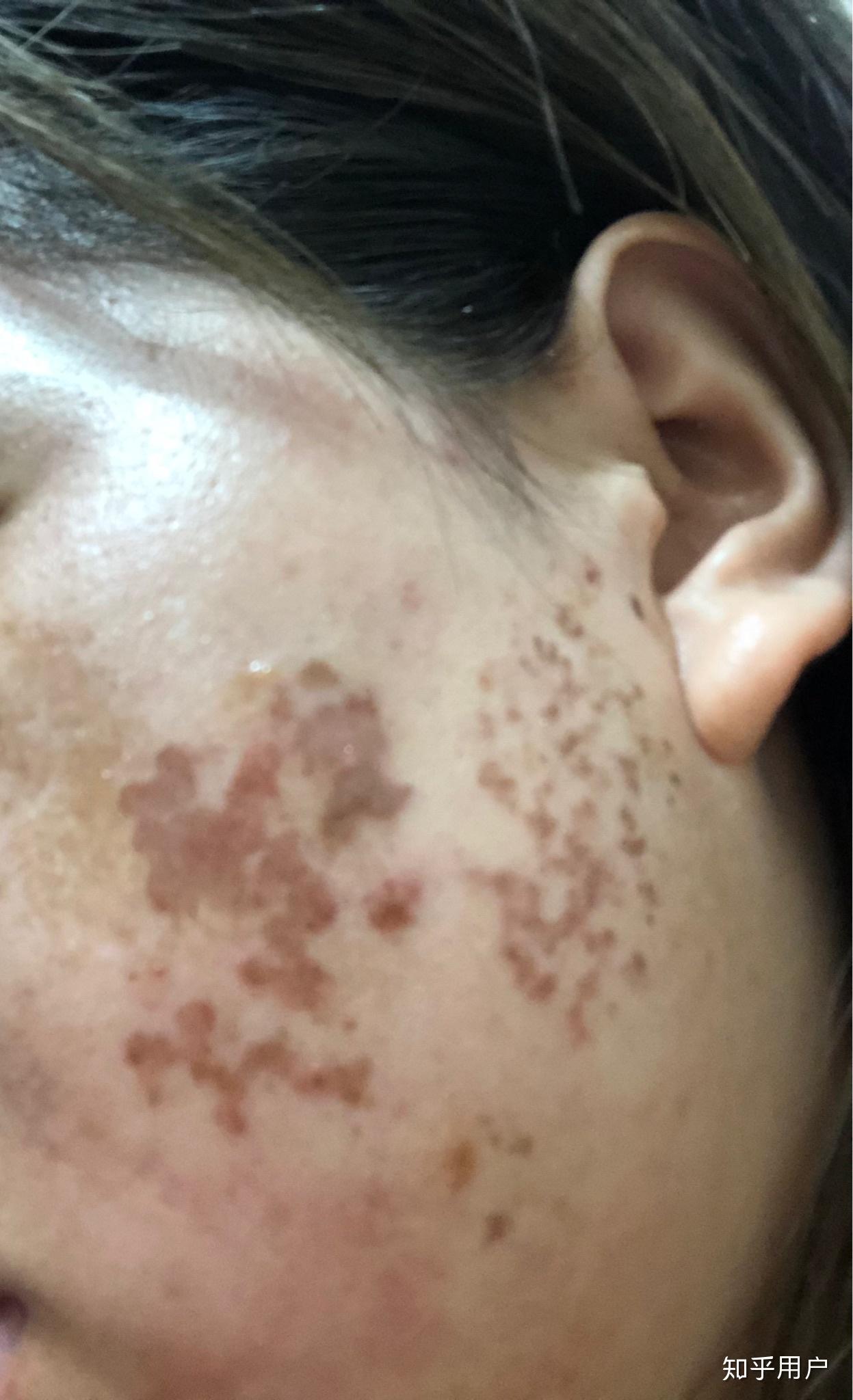 激光祛斑后出水泡会留疤吗? - 知乎