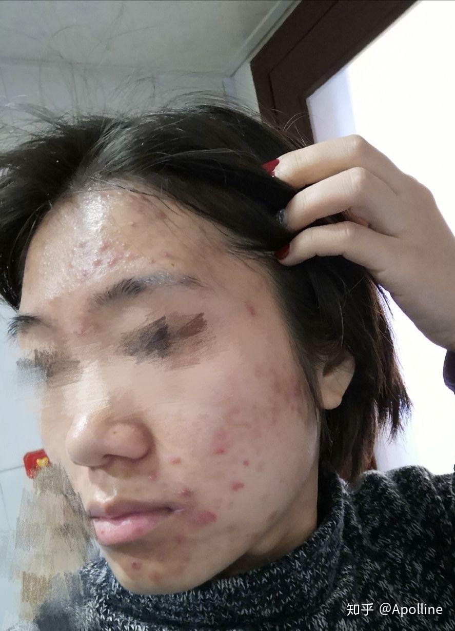 大家用阿达帕林四个月的时候是什么样的