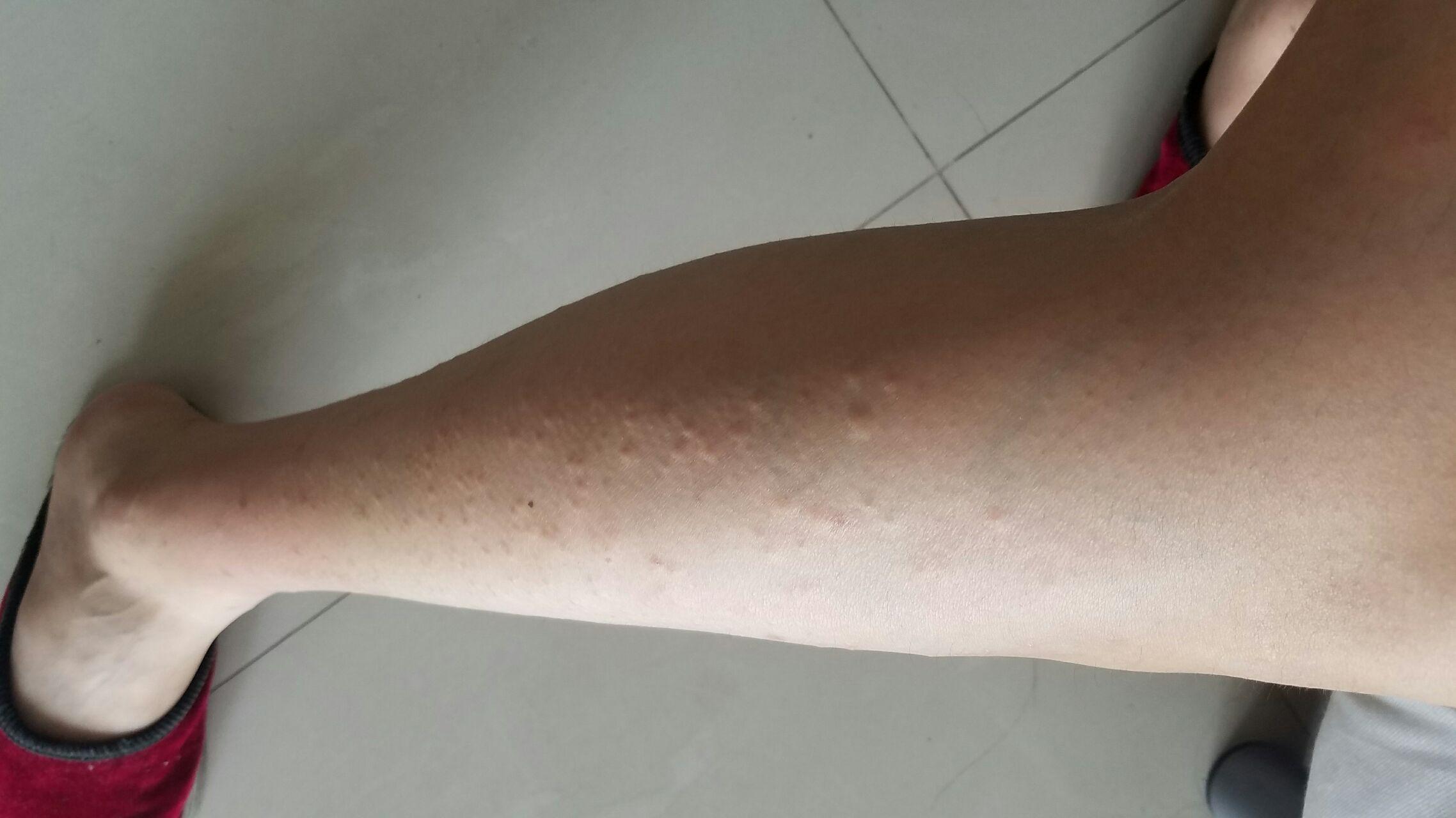 用过激光脱毛仪以后过敏一样有好多痒疙瘩怎么办? - 知乎