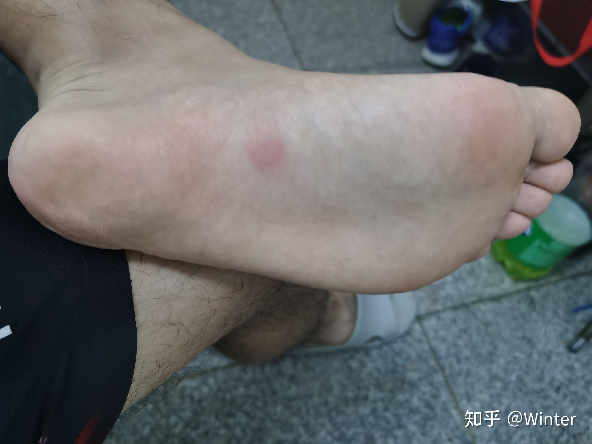 脚掌长这个小红点是什么情况? - 知乎