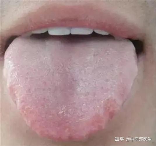 舌有齿痕，我来说说一个方子，对症的朋友可以了解 - 知乎