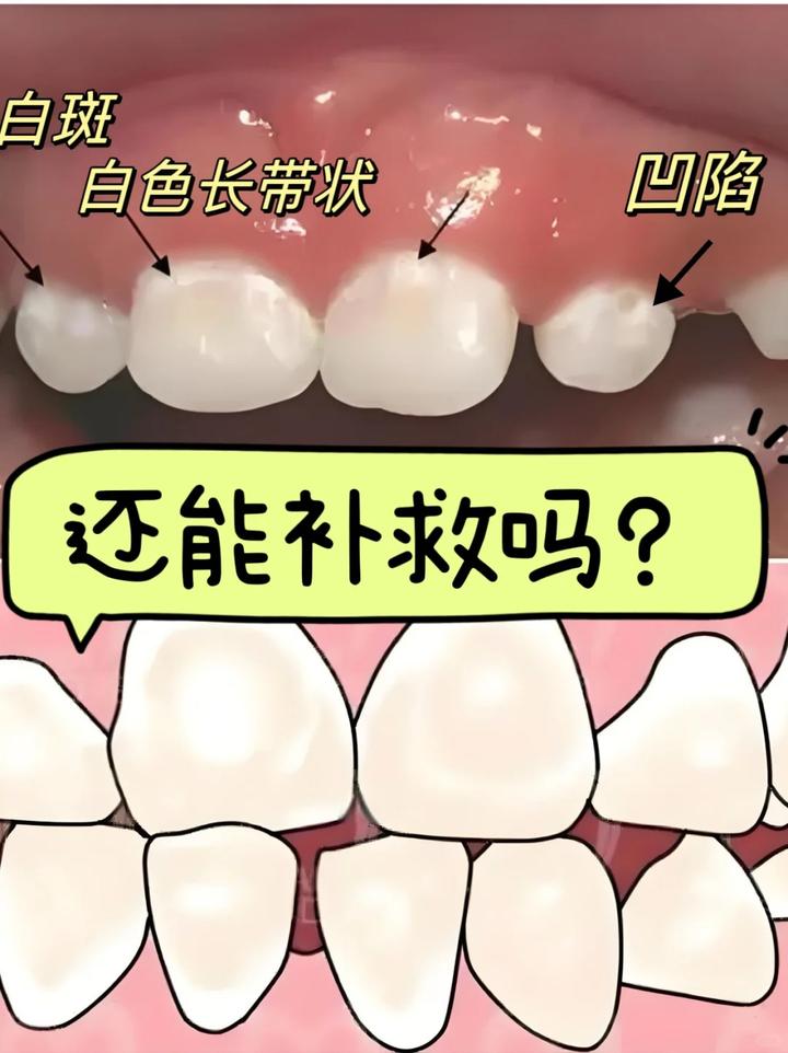5岁乳牙白斑,是脱矿了嘛? - 知乎