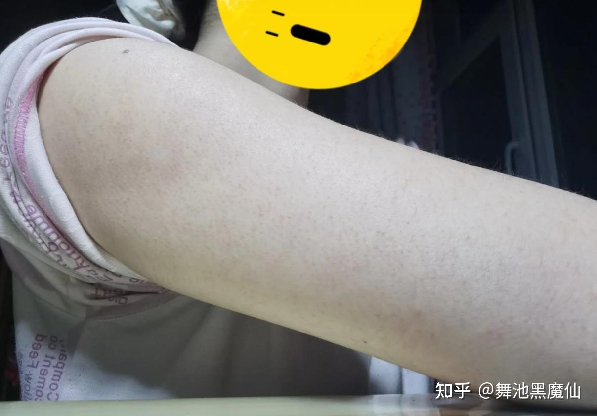 有腿毛的人没有鸡皮肤(腿毛长出来了是不是鸡皮肤就好了)