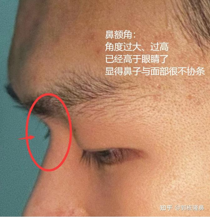 山根也不低,额头也不低,这样的小鼻额角算怎么回事? - 知乎