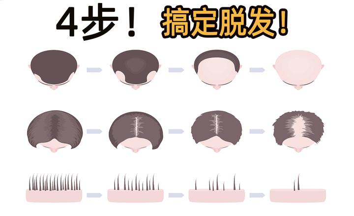 年纪轻轻发缝宽得好似条通天河，头发在地上、在桌上，就是不在自己的头上，救命，90后到底要如何战胜脱发？在两个月内实现发量自由！ - 知乎