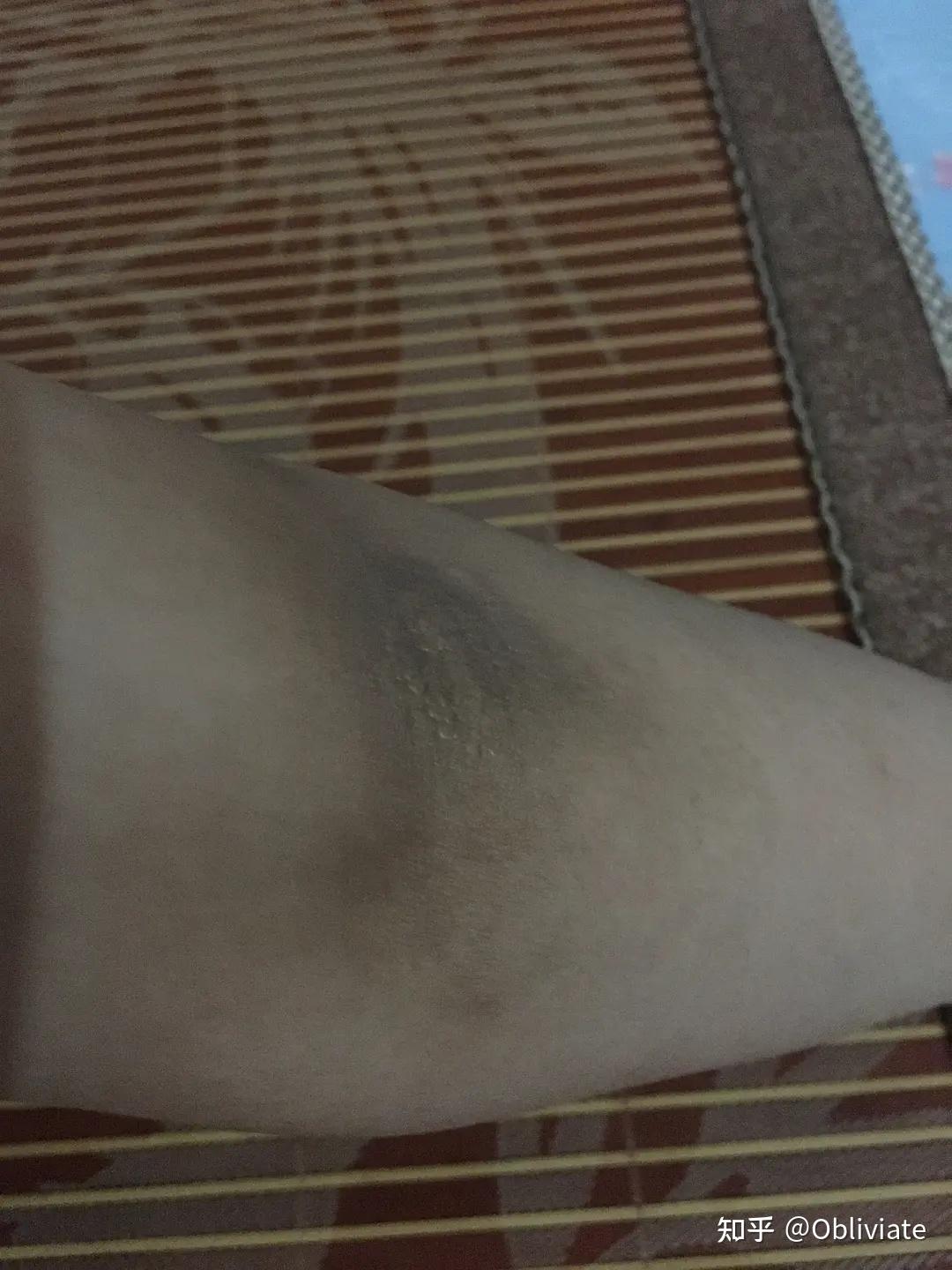 有没有姐妹也和我一样呜呜大腿内侧黑色素沉淀比较严重啊唉