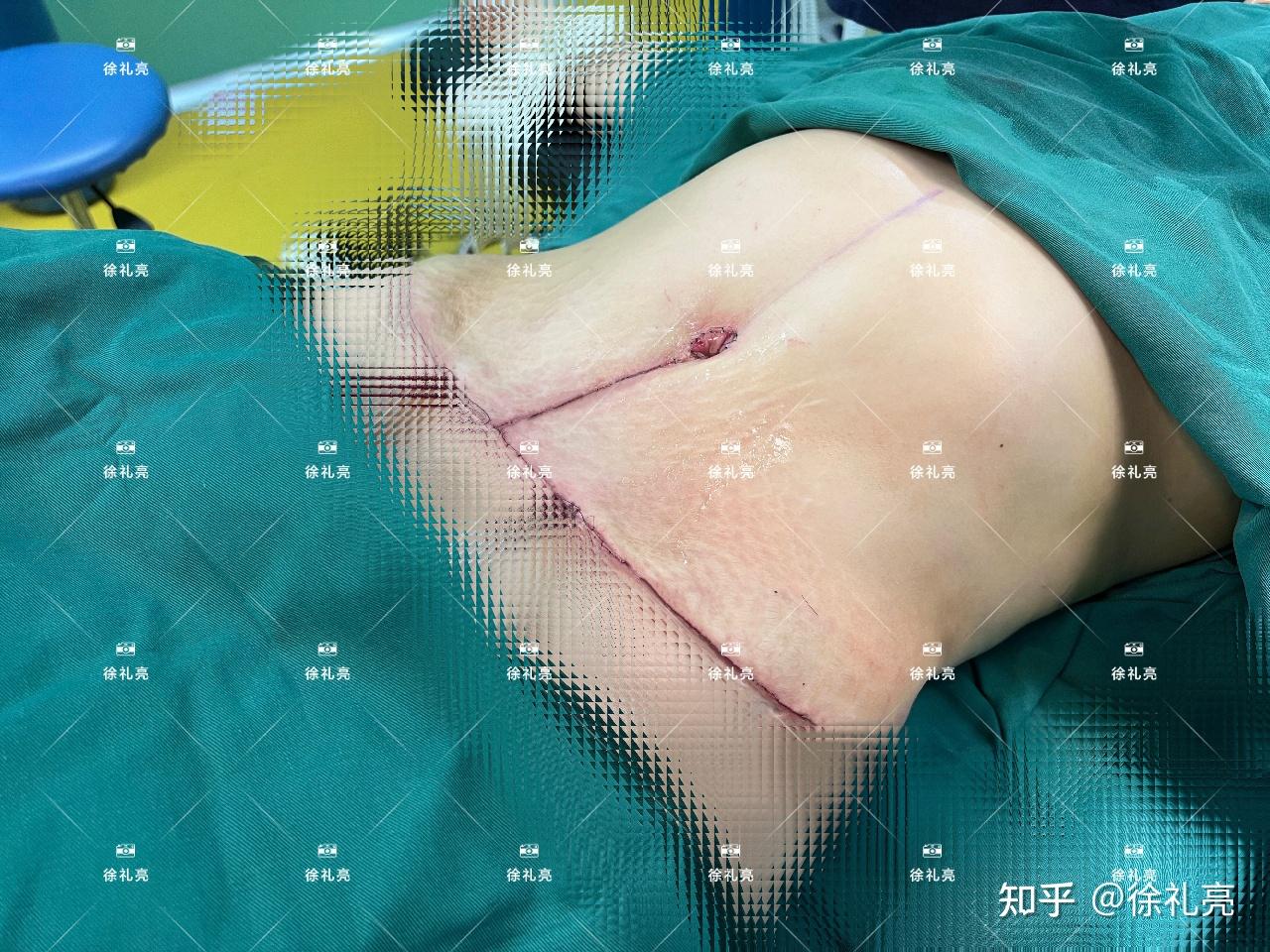 有人做过腹壁整形嘛? - 知乎