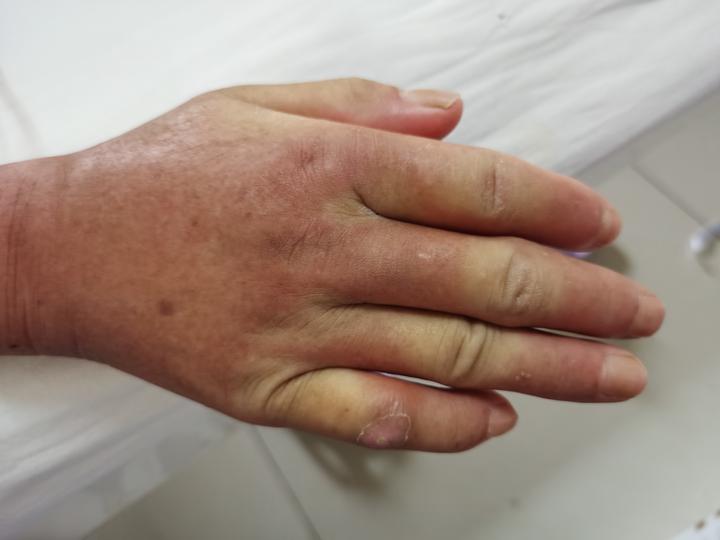 硬皮病患者手指出现雷诺现象怎么办