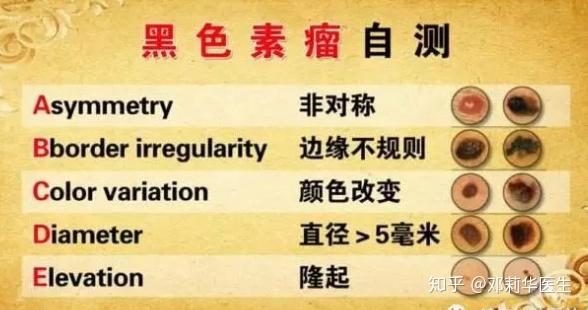 小黑痣和痦子你分得清吗？ - 知乎