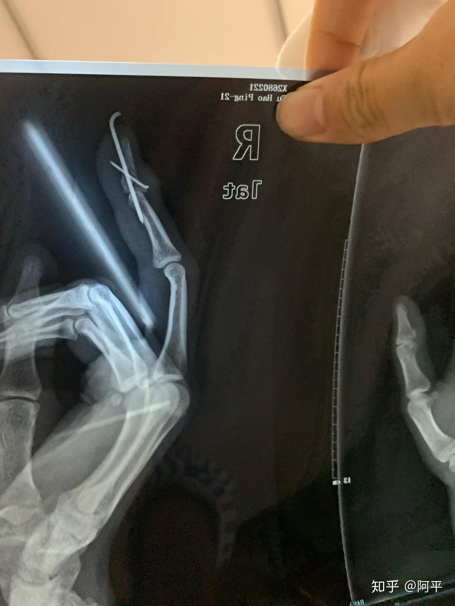 手指肌腱断裂,最后一节无法伸直.医生教我不要治疗了.请问我该怎么做?