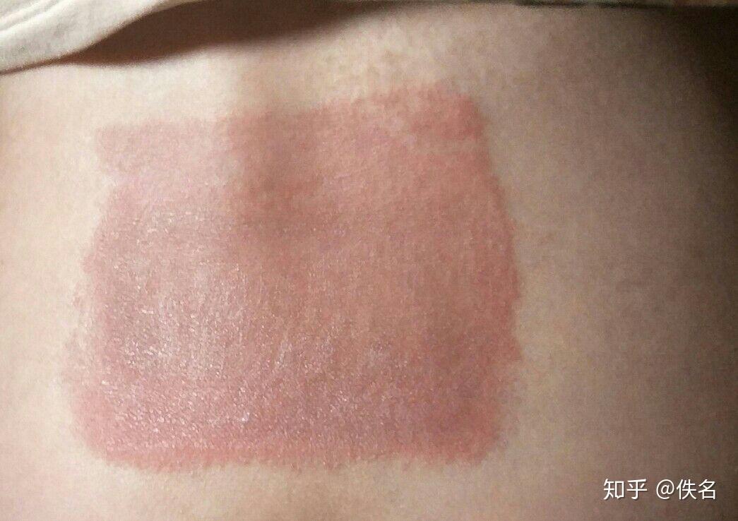 贴膏药过敏怎么办? - 知乎