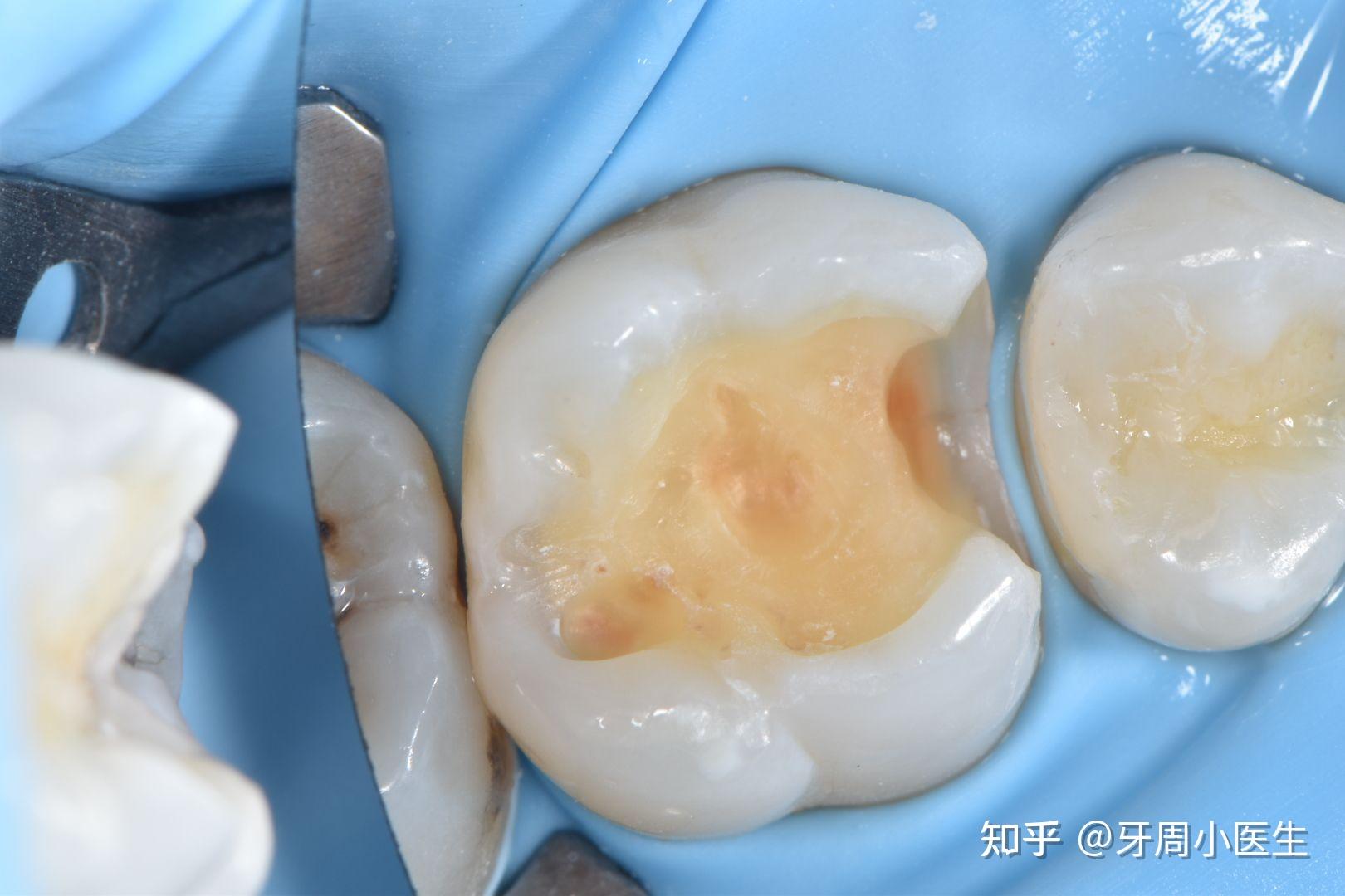 3m唯美树脂补牙一颗400正常吗