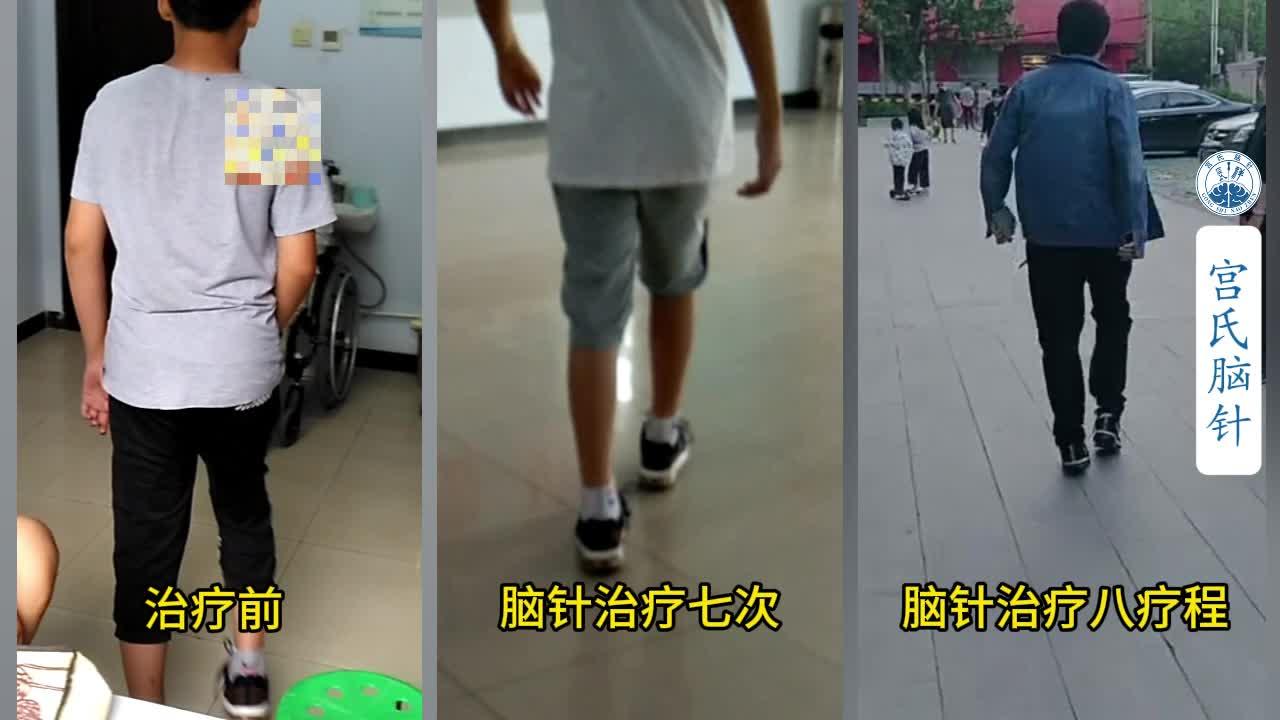 脑瘫少年的感恩之心以后我也要学宫氏脑针