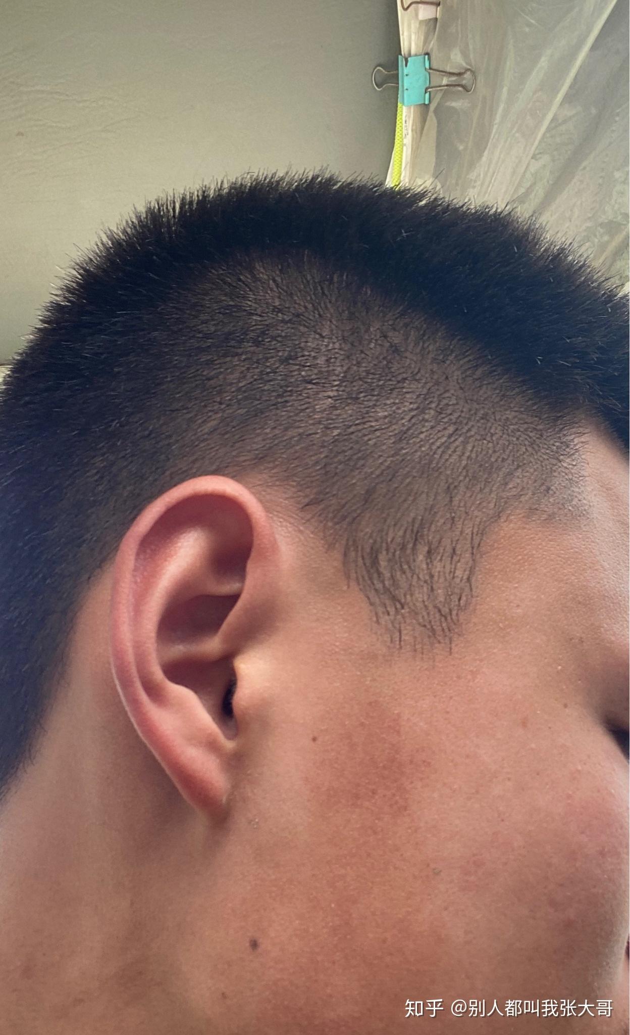 脸颊两侧发黑是怎么回事呀,怎么能解决啊 ?