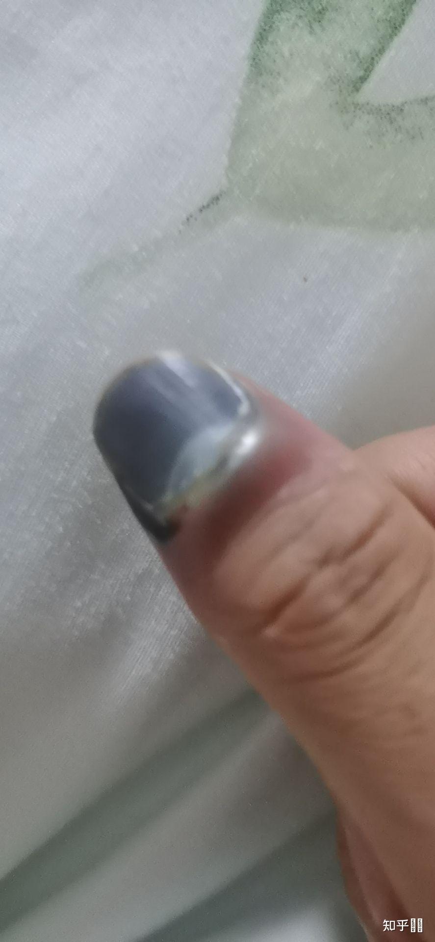 指甲被车门挤伤 指尖全是淤血 怎么办?