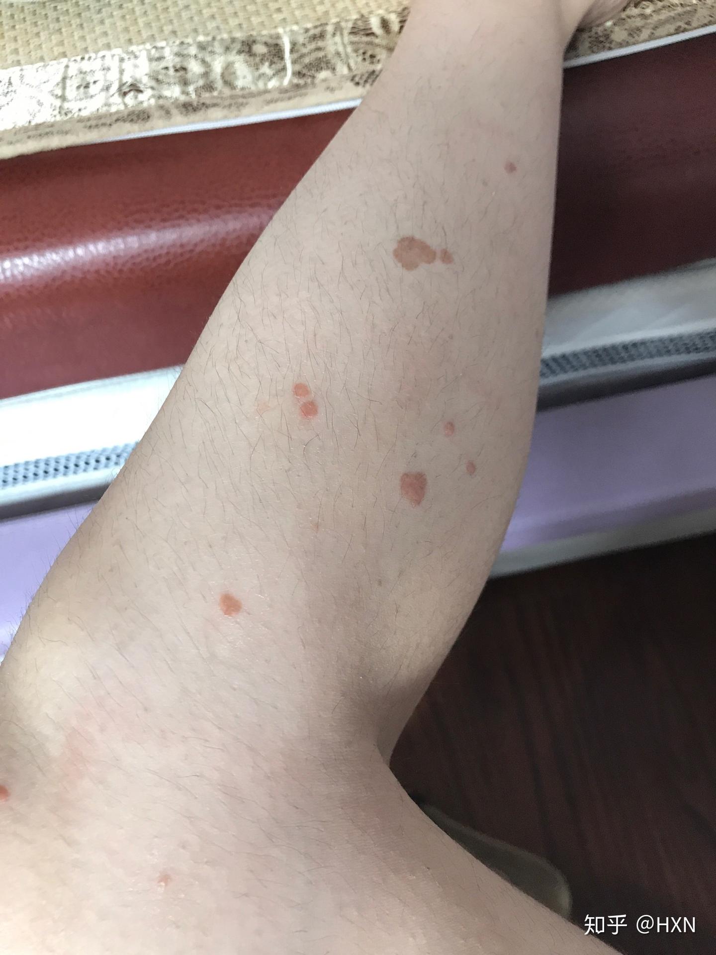 我治疗扁平疣的经历 - 知乎