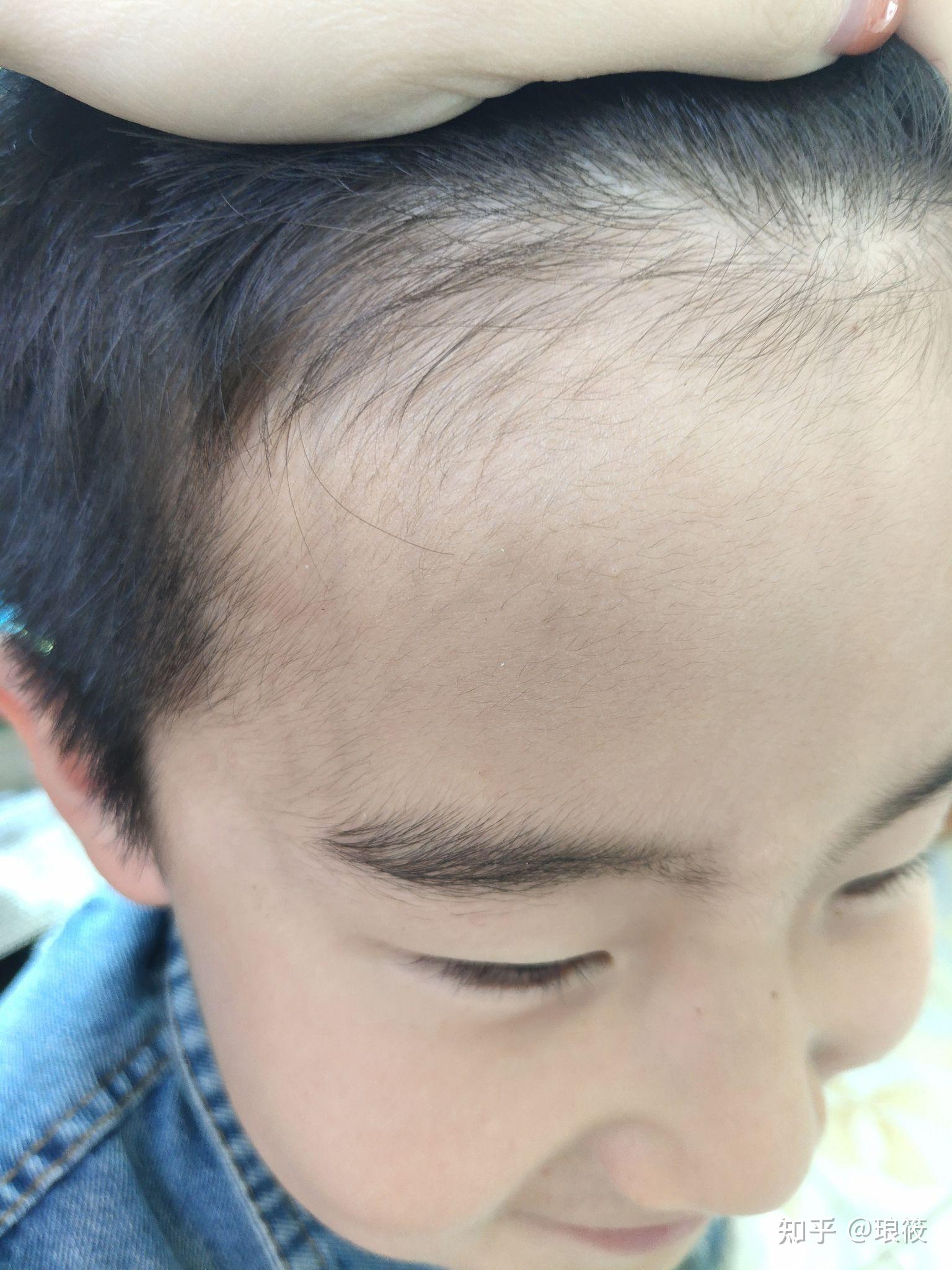北京画家纹发际线/我的发际线拯救我的小秃头 - 知乎