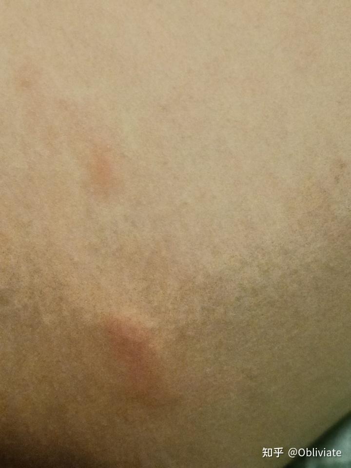 大腿根部长这样的包是怎么回事?