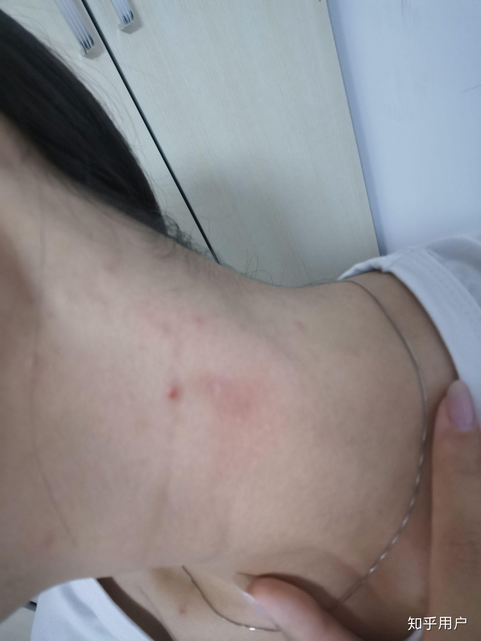 怎么在三小时内消除吻痕？ - 知乎