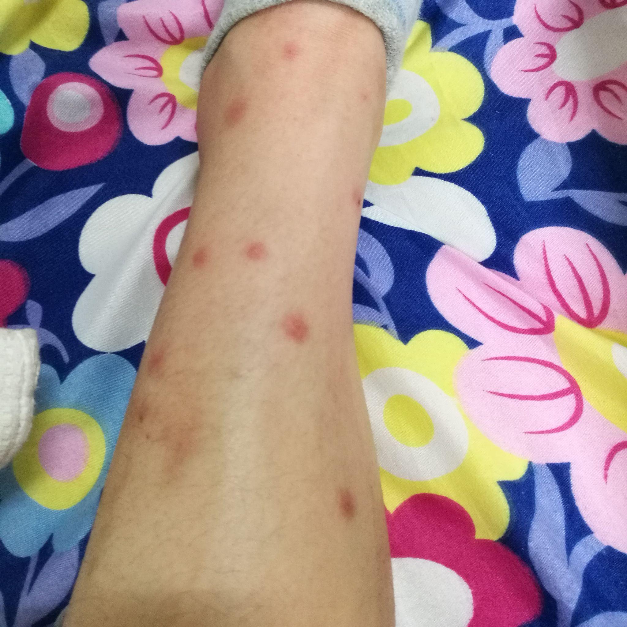 被跳蚤咬的全身都是包是什么样的感受