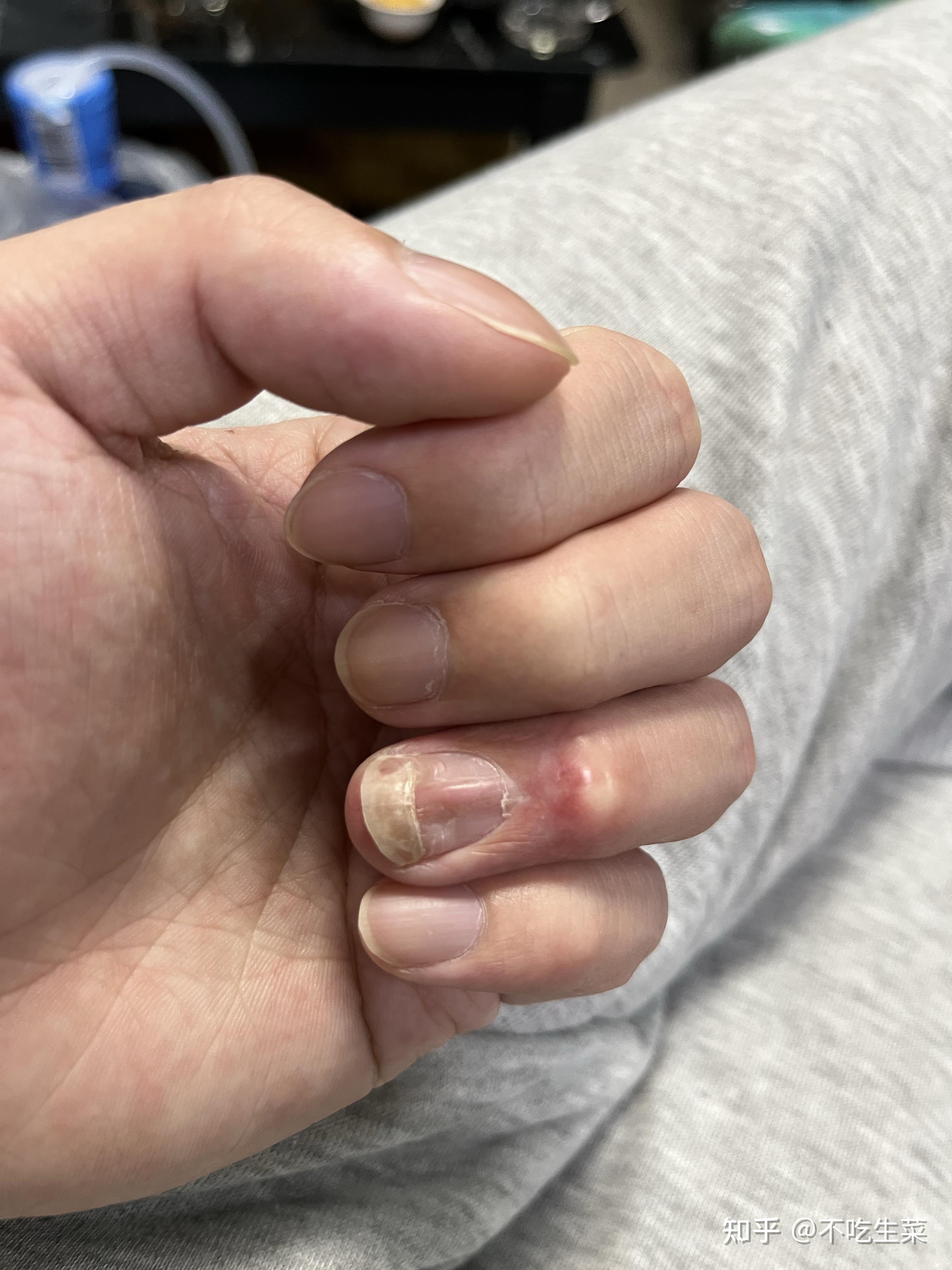 手指头骨折是种怎样的体验? 