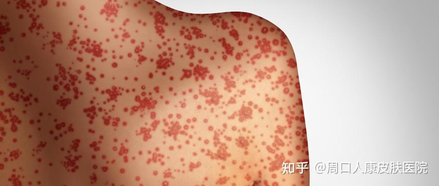 荨麻疹和荨麻有什么关系吗? - 知乎