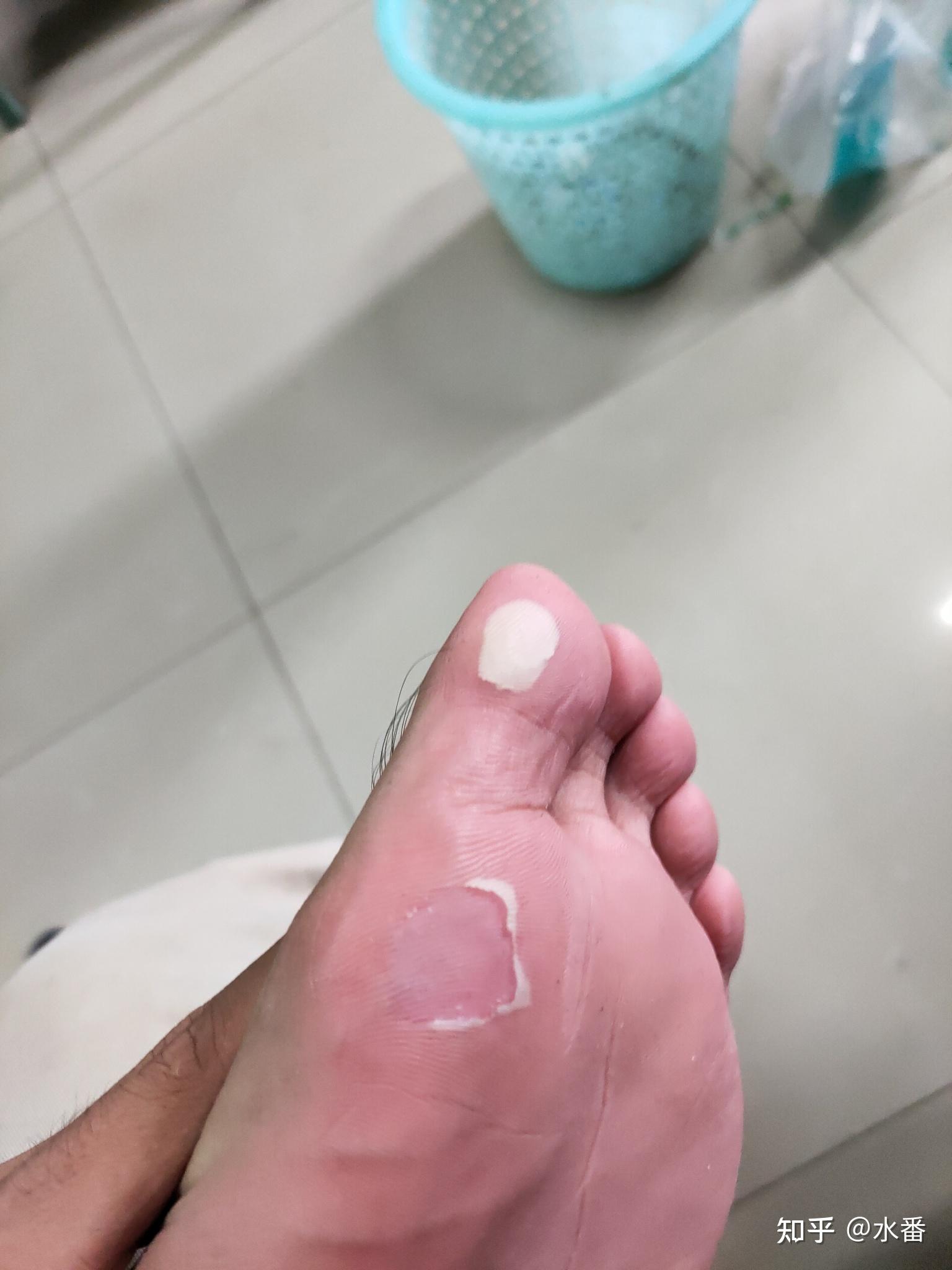 脚上磨出水泡该怎么办? - 知乎