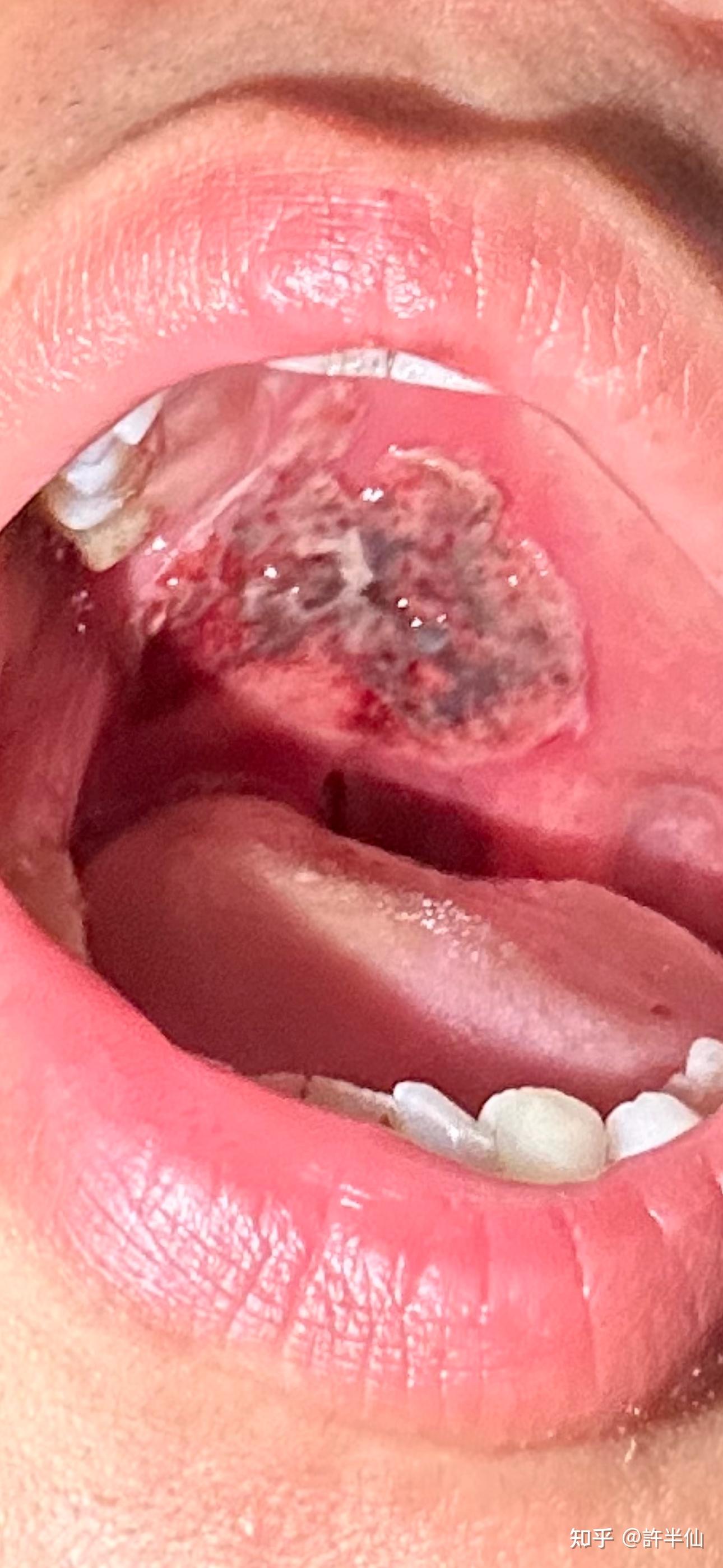 你见过最大的口腔溃疡有多大?