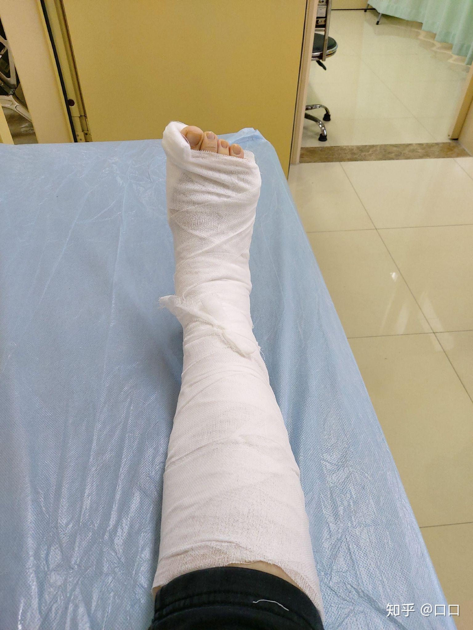 脚踝骨折是一种怎样的体验? - 知乎