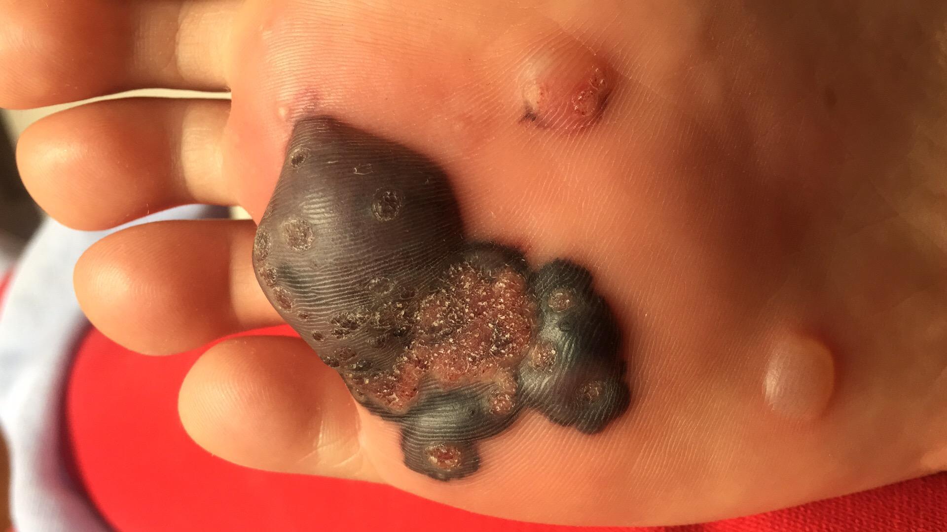 甲下寻常疣做液氮冷冻疼哭了可耐受疼痛真的这么厉害吗还是我太弱了