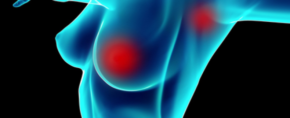 乳腺癌能不能治好，关键看这一个问题- 知乎