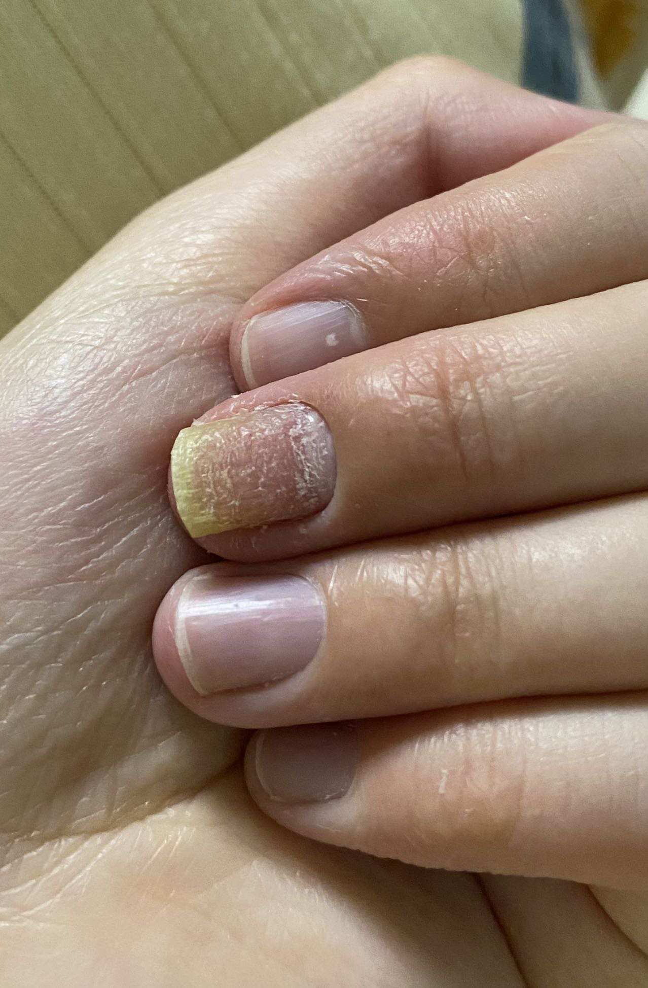 指甲上凹凸不平横向上一条条的是缺钙吗