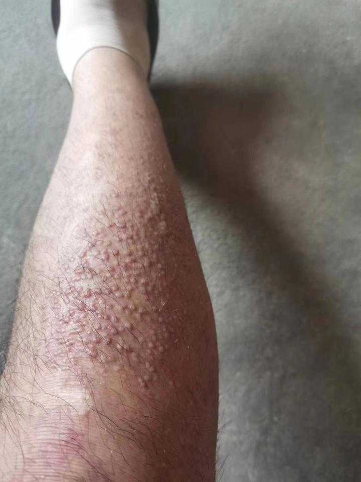 为什么这么多人前期发现不了自己有淀粉样变,和它这两个表现也有关!