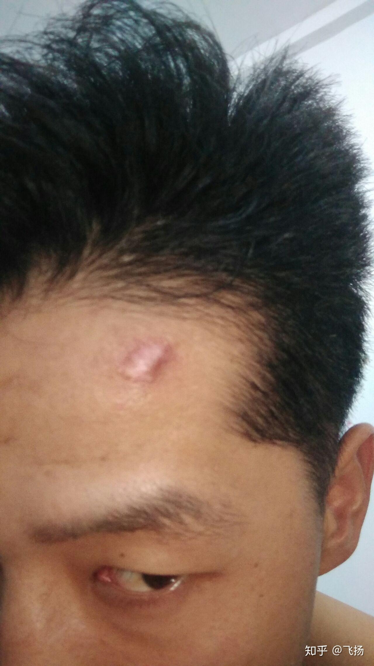 如何消除额头增生性疤痕? - 知乎