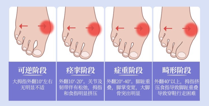 郝雨生,大脚骨在人群中的发病情况是怎样的? - 知乎