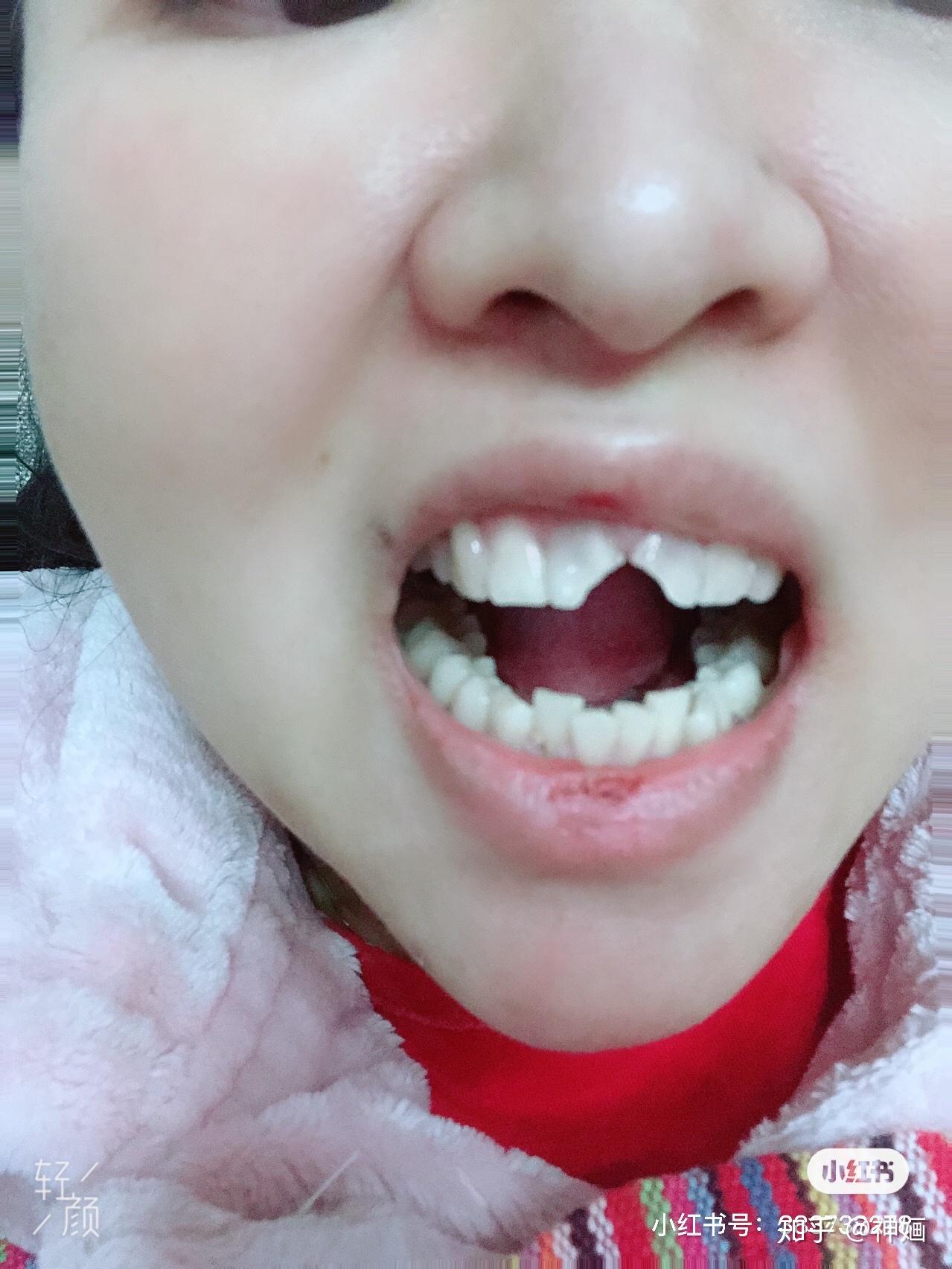 门牙磕掉16大小的一个角牙根没受损是需要补牙还是烤瓷