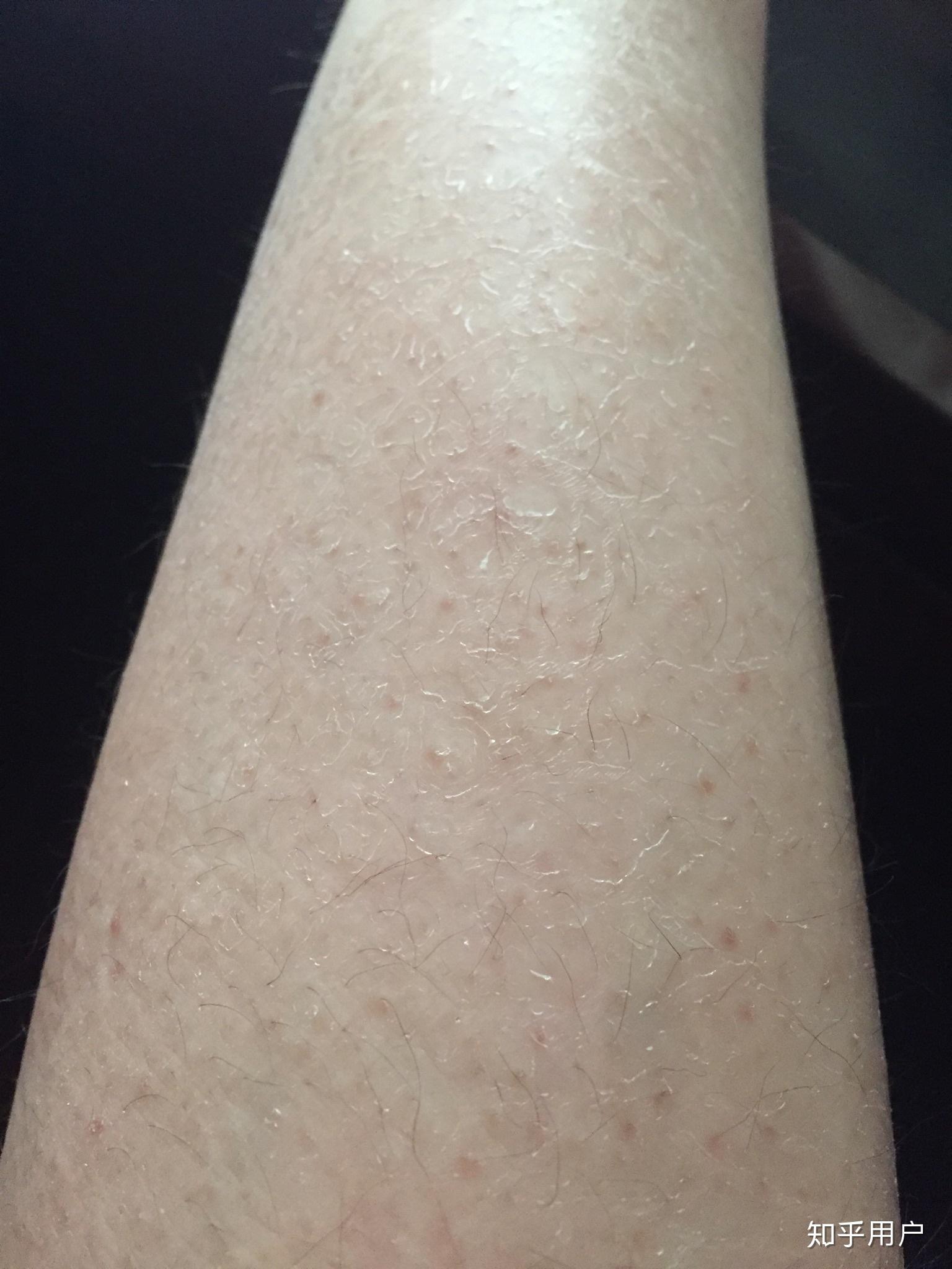 我从出生就有鱼鳞病遗传皮肤病治不好有些自卑怎么办