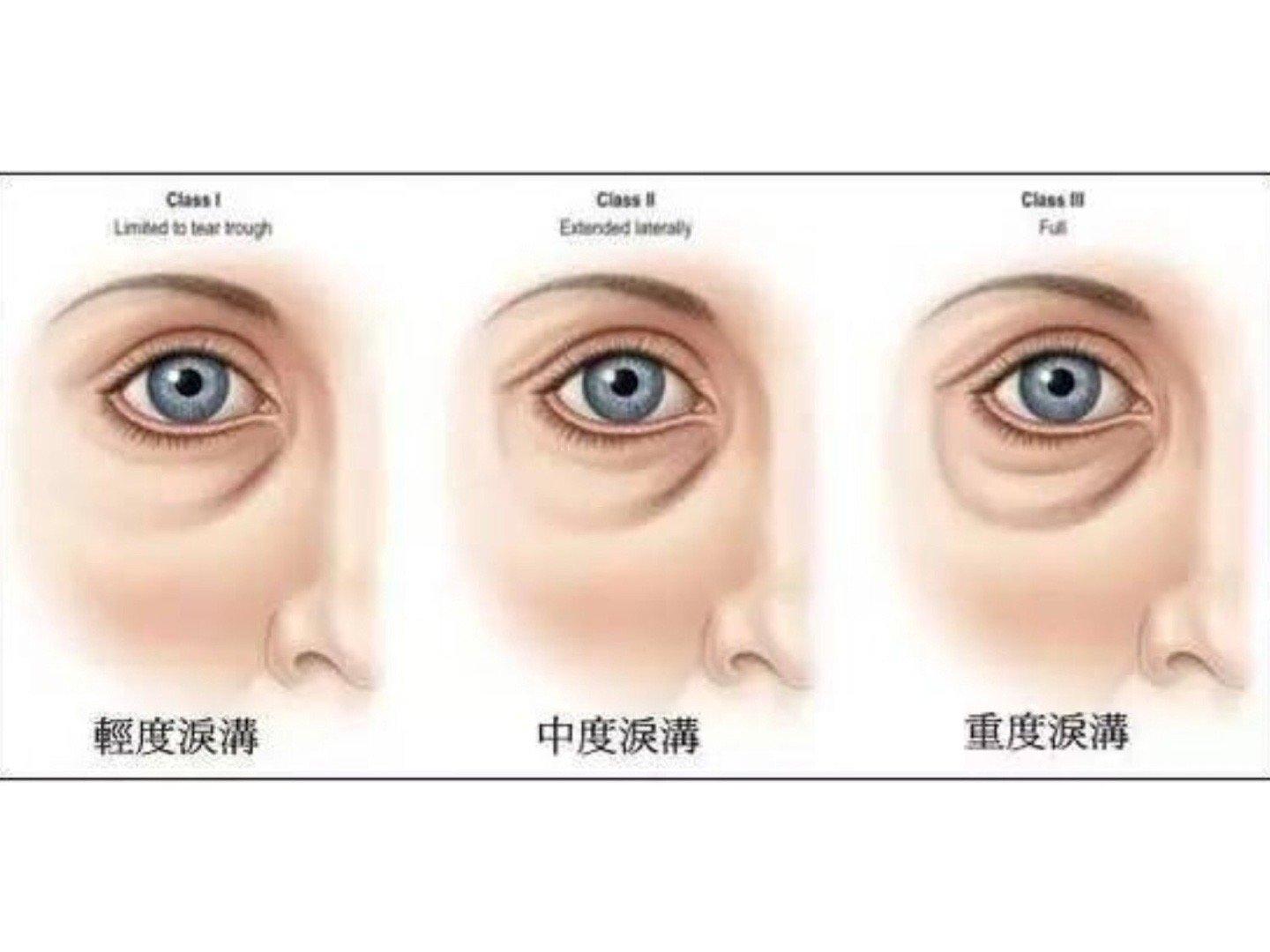 干货来袭，泪沟科普！解决泪沟的这几种方式 - 知乎