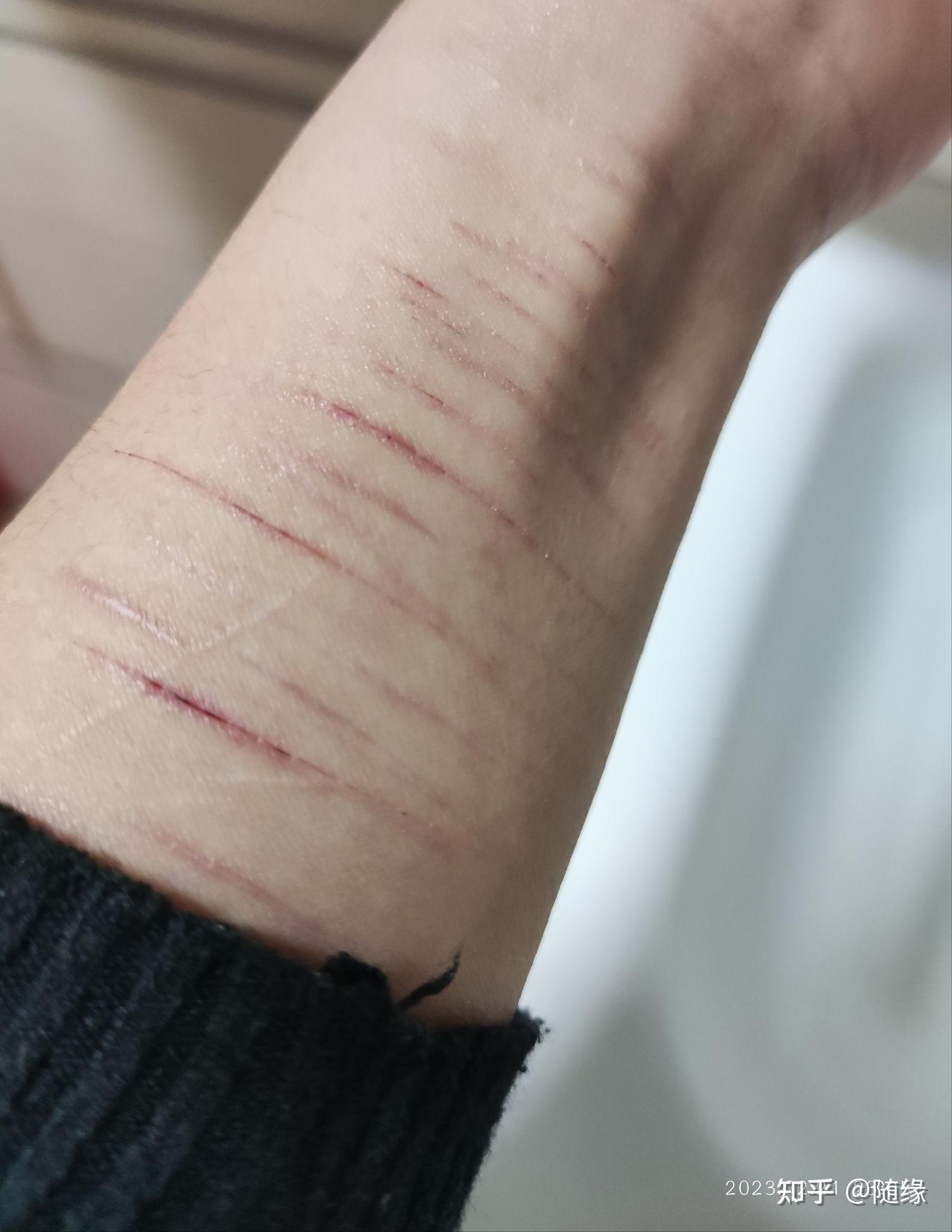 自残留下的疤真的很可笑吗
